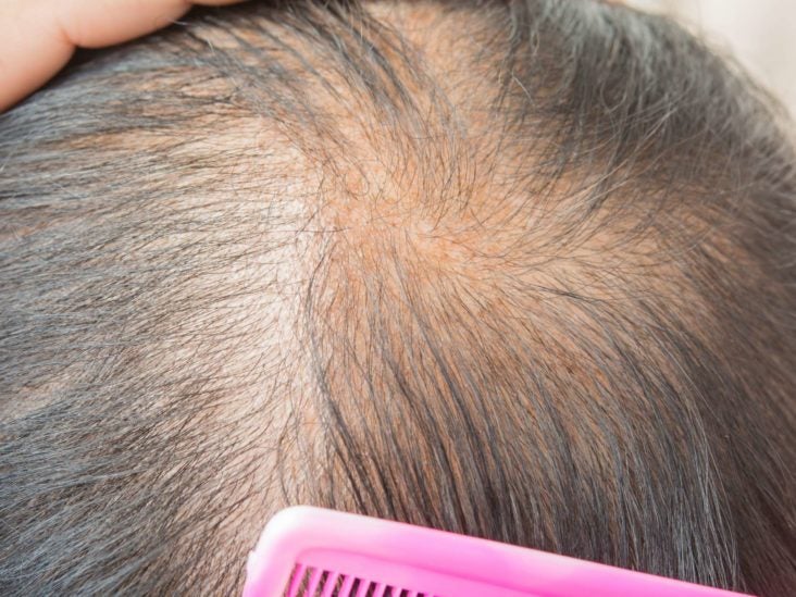Multiple hairs growing out of one follicle
