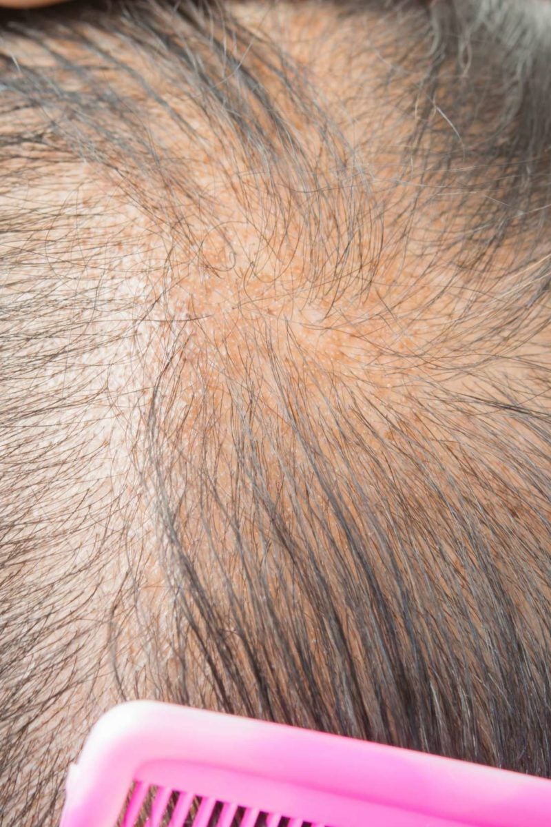 Alopecia reverse naturally androgenetic Can Androgenic