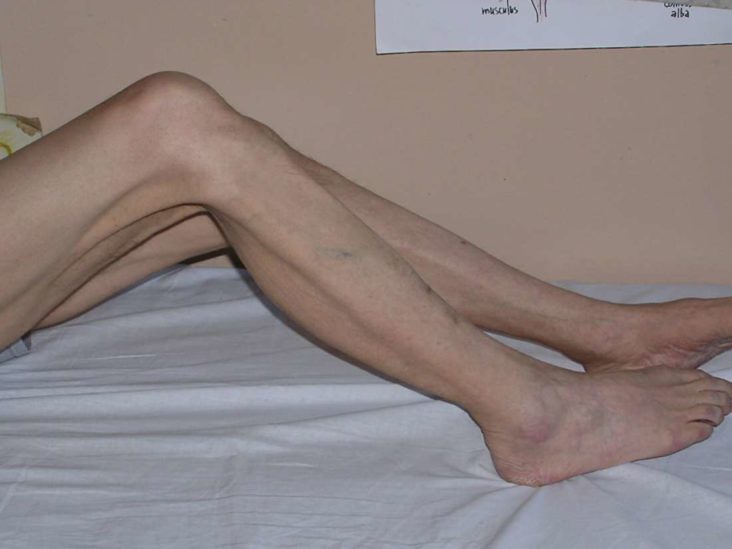 leg muscle atrophy