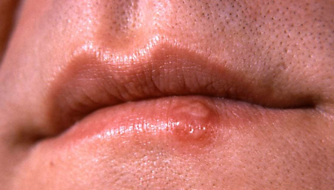 chlamydia mouth sores