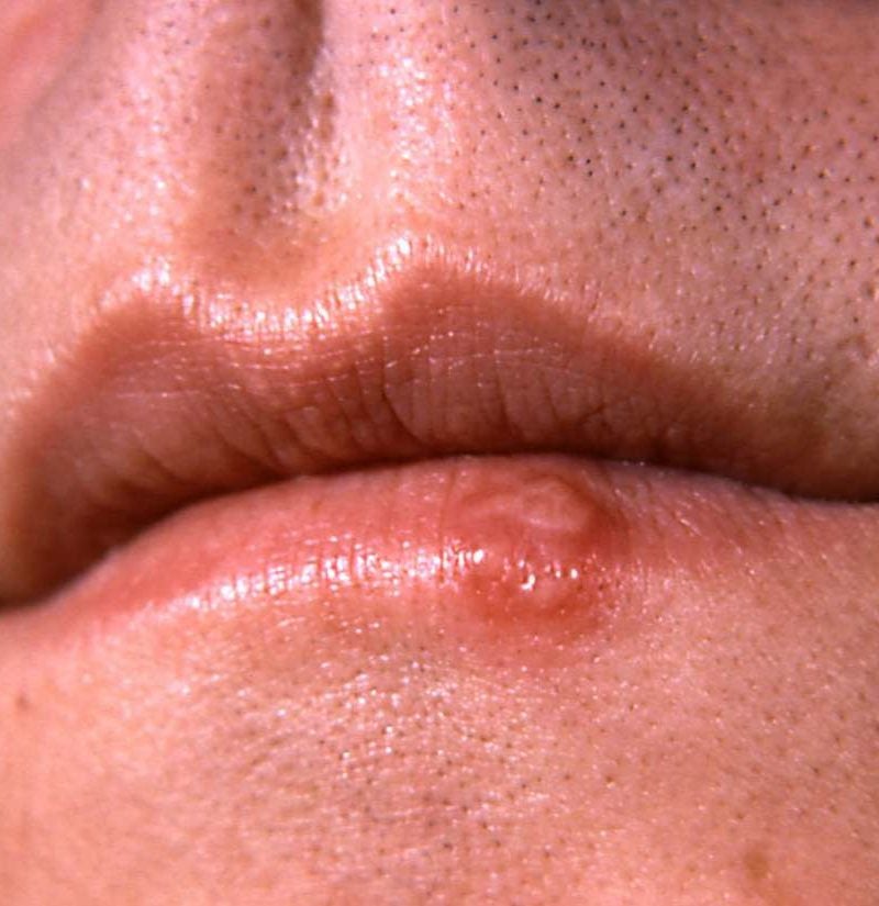 hpv on lips