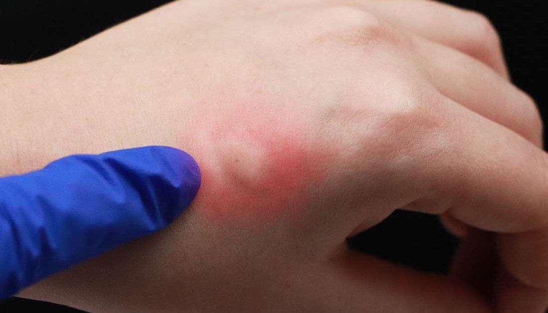 How long do allergic reactions to bug bites last