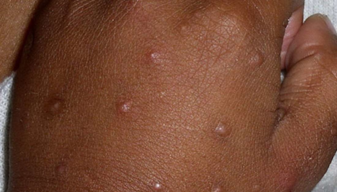 clusters of bumps on skin