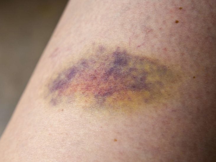 Reason no yellow for bruising What Causes