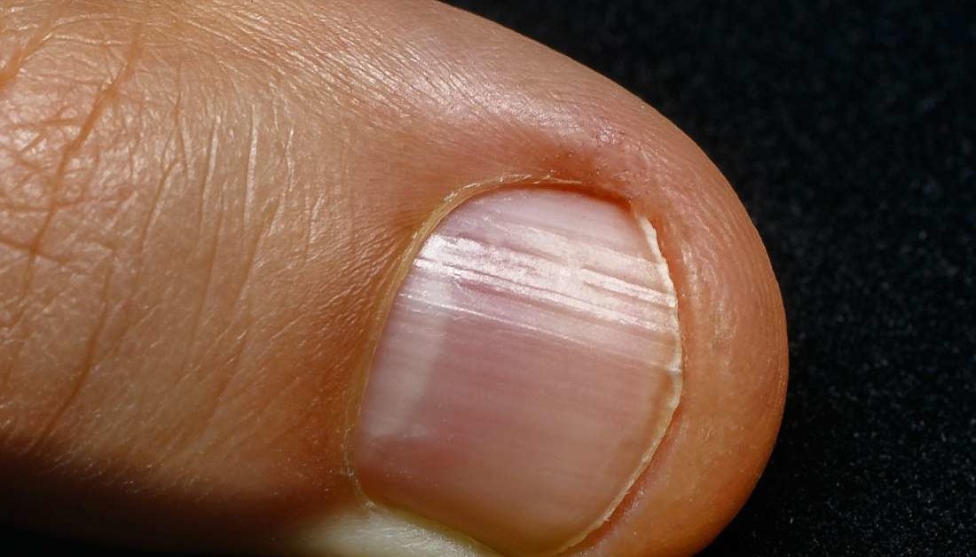 Rochester Hand Center - Nailbed Injuries
