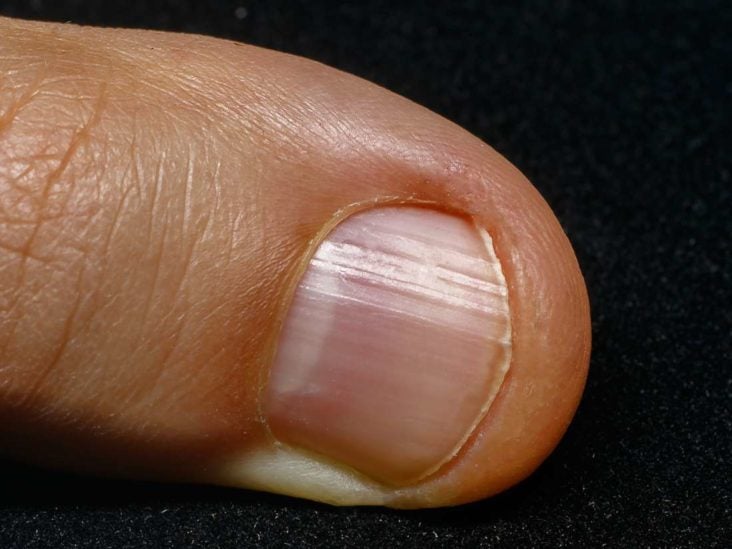 Curved nails: Causes of spoon nails and curved tips and sides