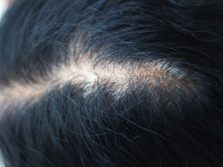 Can dandruff lead to hair loss? The link, causes, and treatments