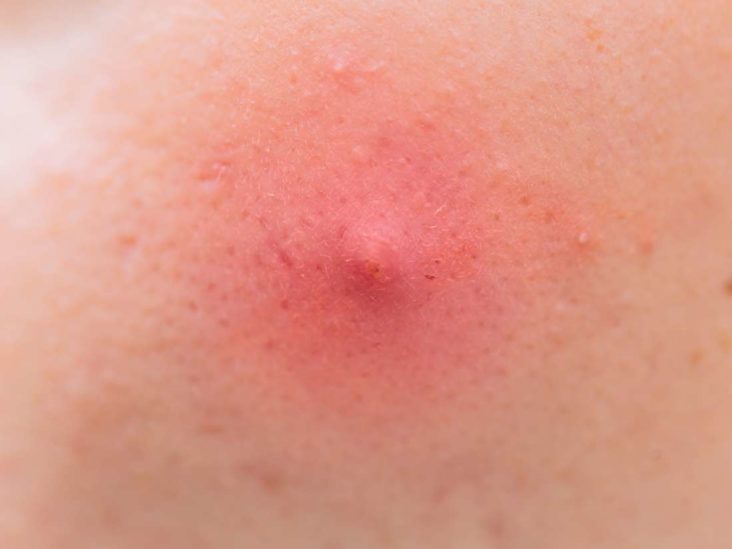 4 Tips for Underarm Care After Lymph Node Removal: Odor, Rash, and More