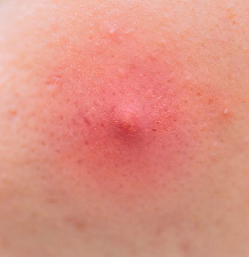 Armpit Pimple Types Causes And Treatments