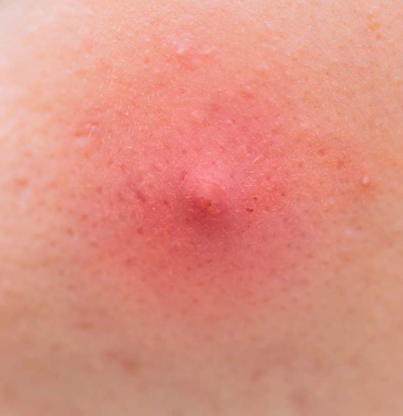 armpit-pimple-types-causes-and-treatments