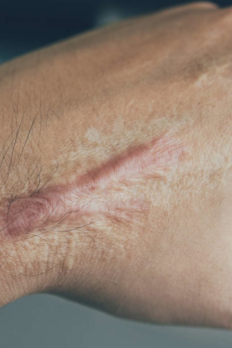 Ultrasound Scar Tissue Treatment at Troy Braxton blog