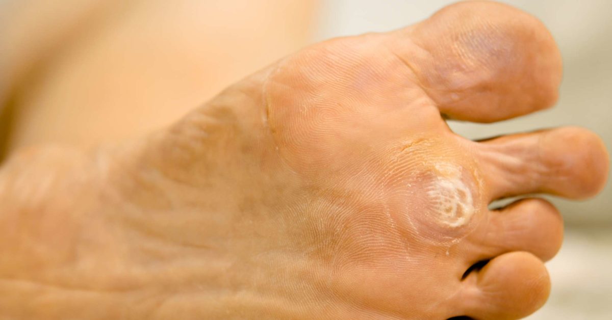 foot wart under skin