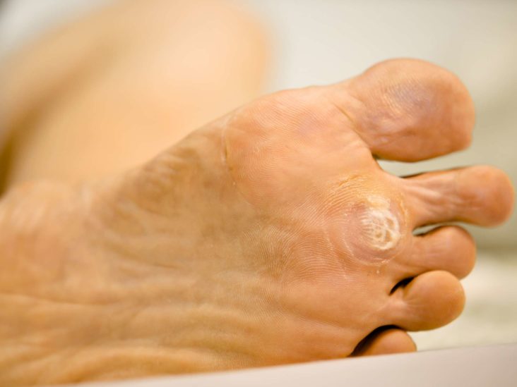 foot wart nerve pain
