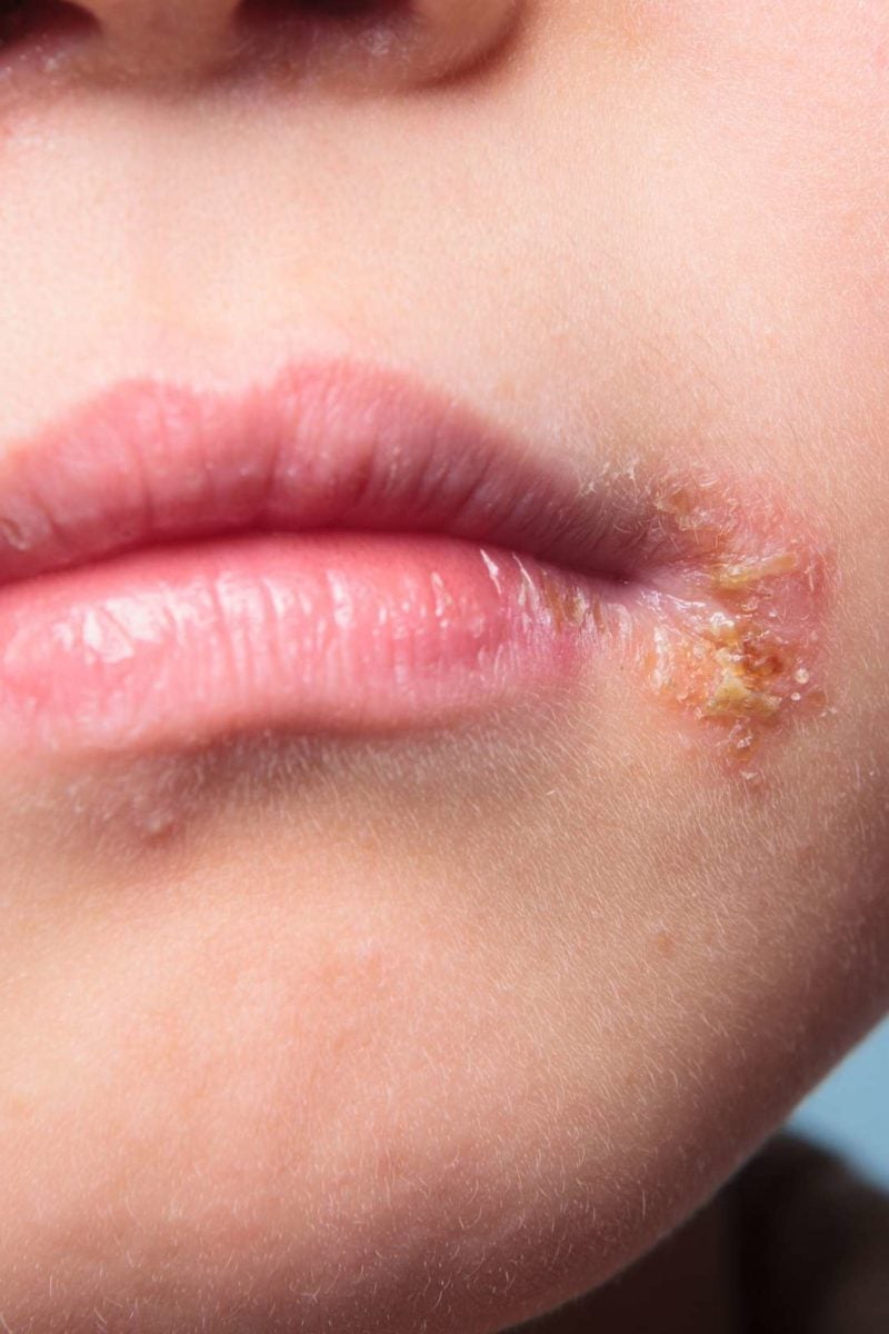 Infected blister: Symptoms, first aid, treatment, and healing