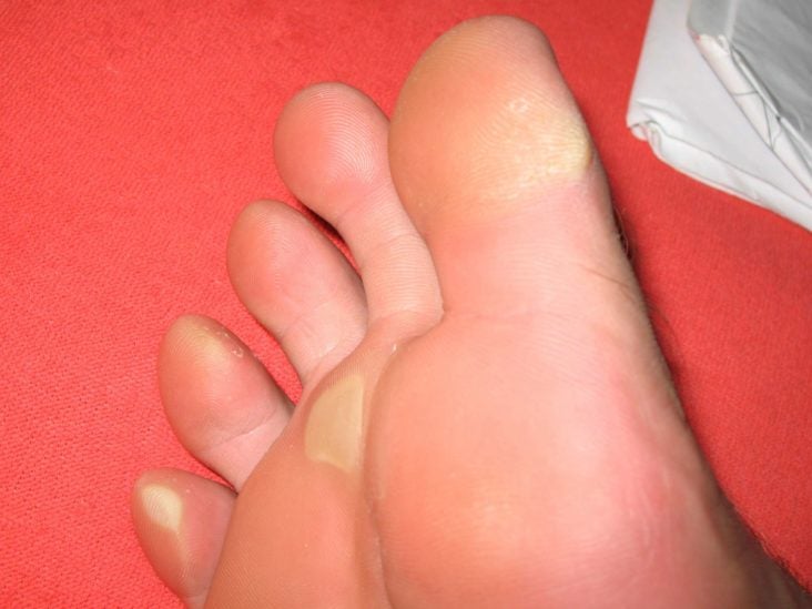 Purple Feet: Causes And Treatment