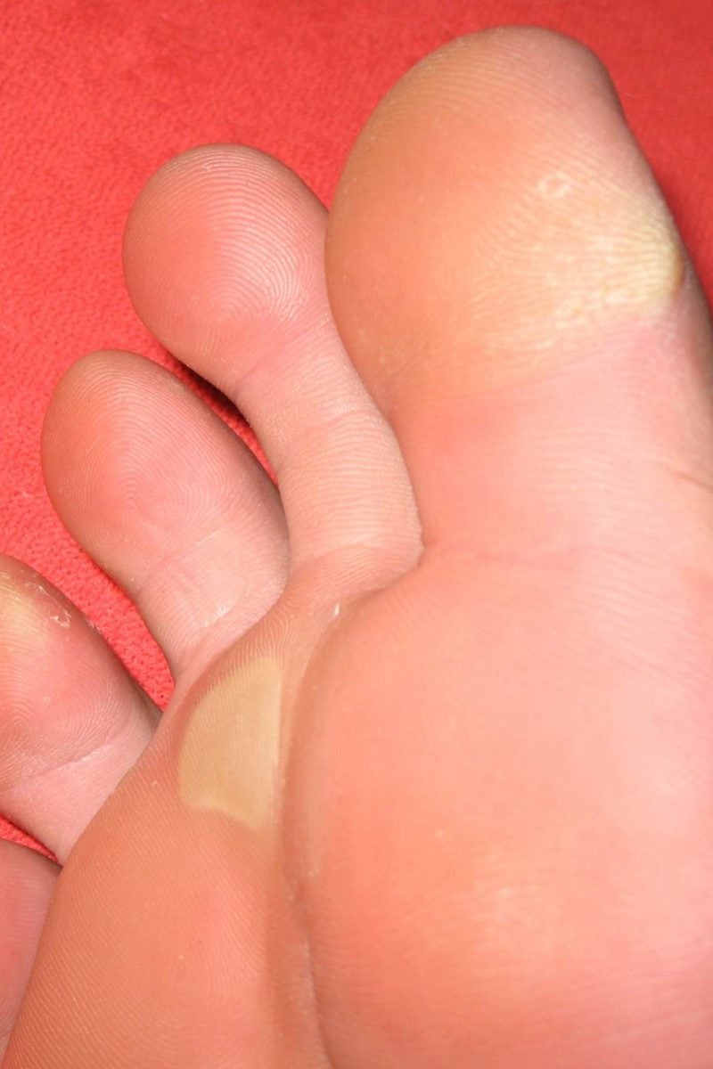 Yellow feet 6 potential causes