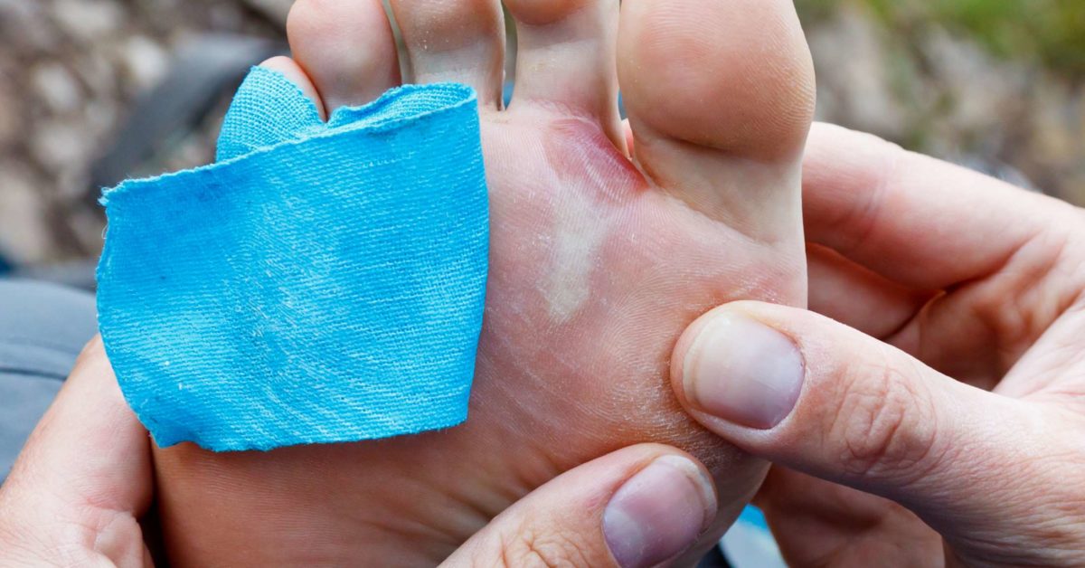 Pinch Callous: Evidence Of Taping Gone Wrong - Blister Prevention