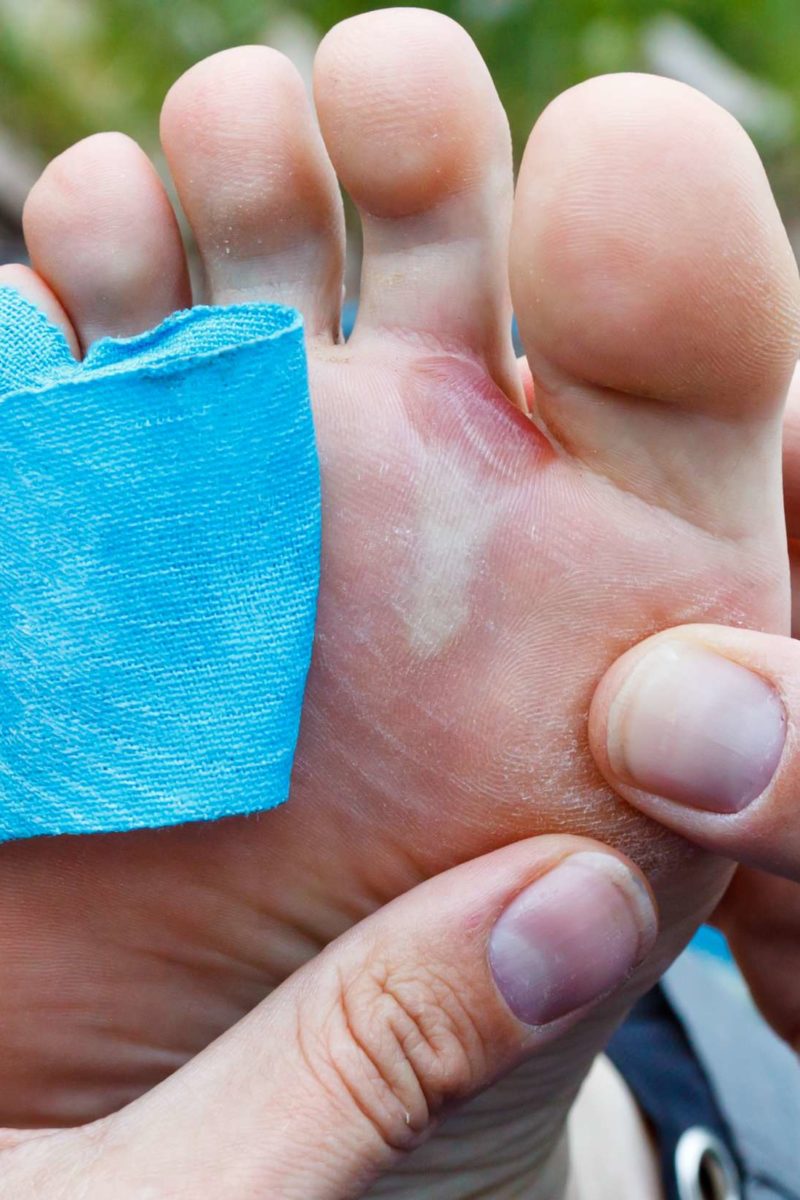 Should you pop a blister? When to do it, safe methods, and tips