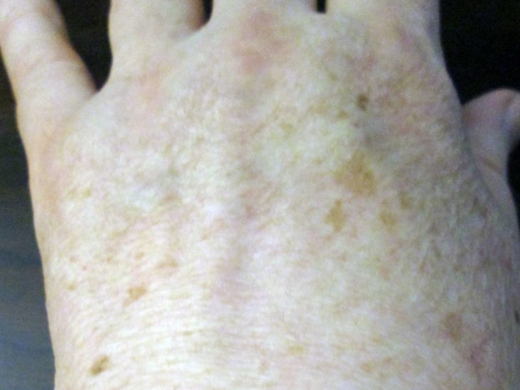 melanin increasing cream