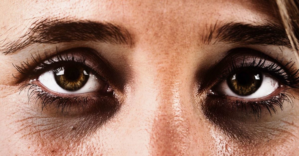 How to Get Rid of Dark Circles Under-eyes