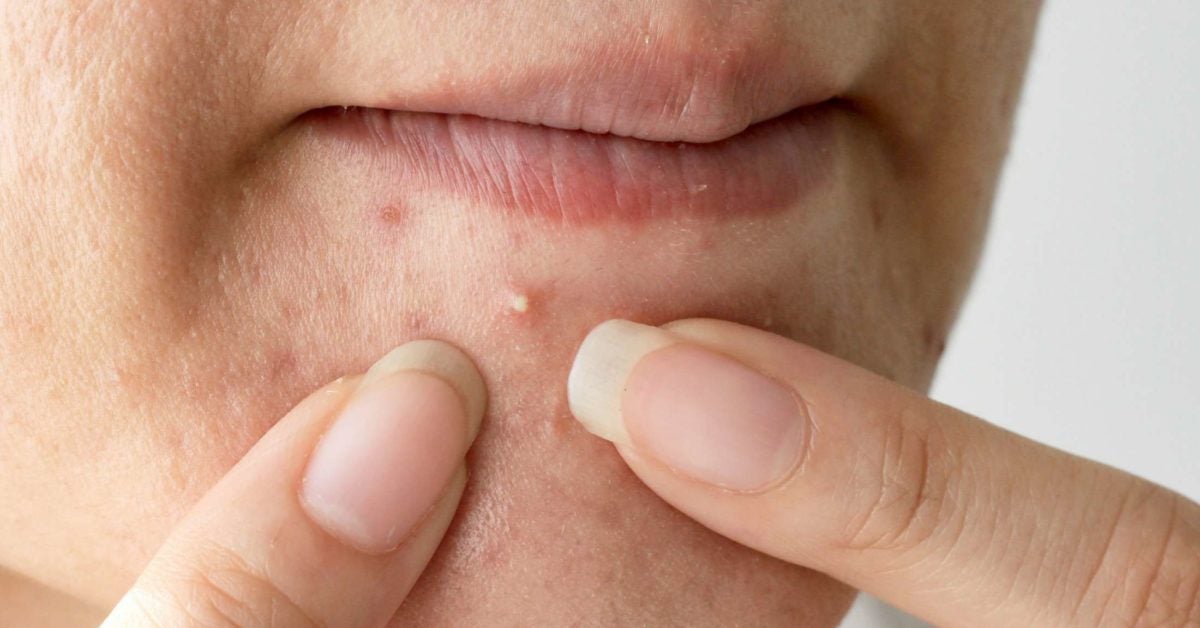 pimples-on-the-chin-what-it-means-and-how-to-get-rid-of-them