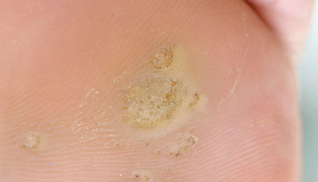 wart on foot keeps coming back)
