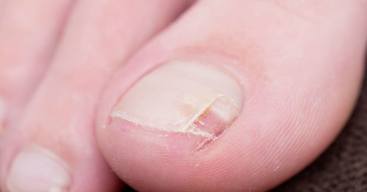 How to identify the cause of a nail break - Scratch Magazine