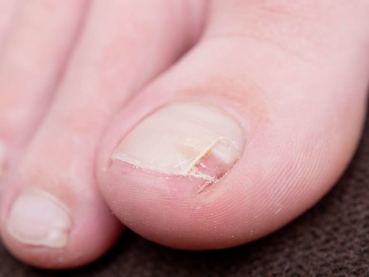 How To Fix A Split Nail Causes Treatment And Prevention