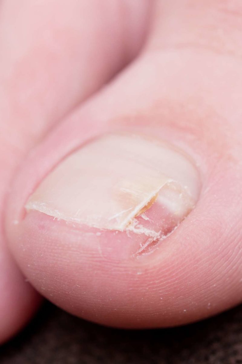 nail treatment for splittin