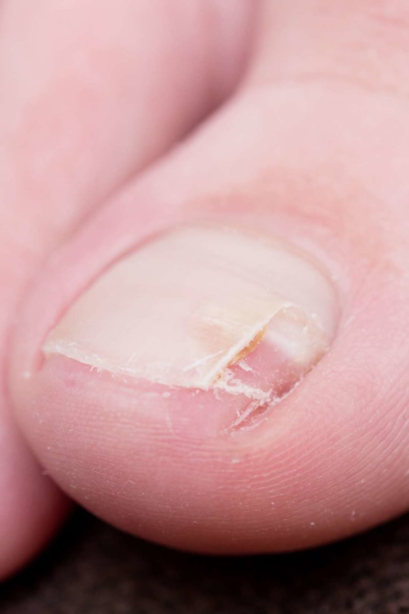 Top more than 124 my nail came off best - ceg.edu.vn