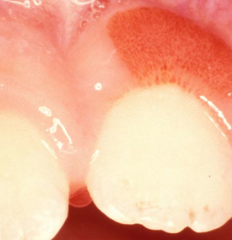 Swollen gum around one tooth: Causes and treatment