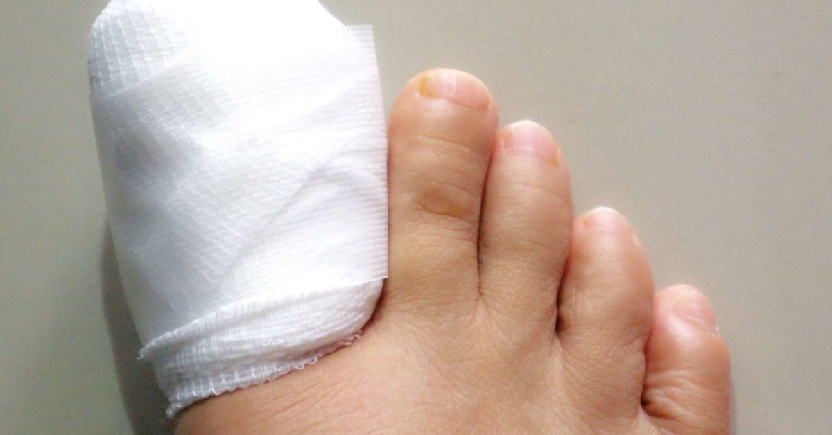 ingrown toenail removal before and after