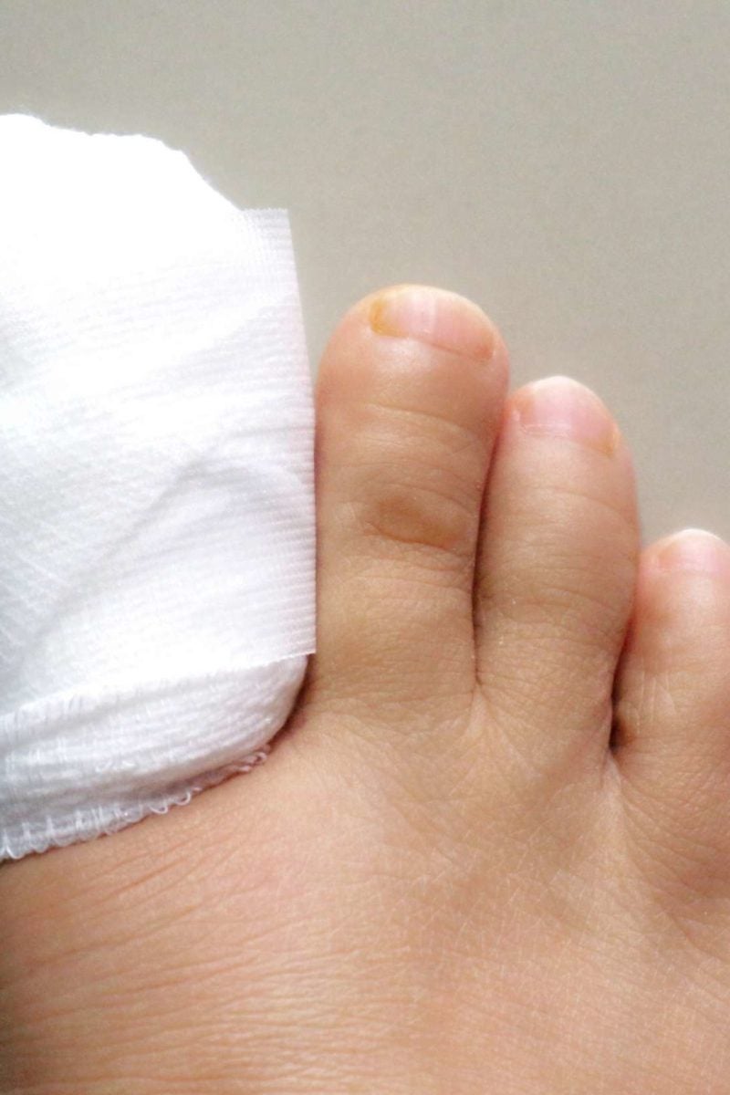 Surgery For Ingrown Toenails Procedure Recovery And Risks