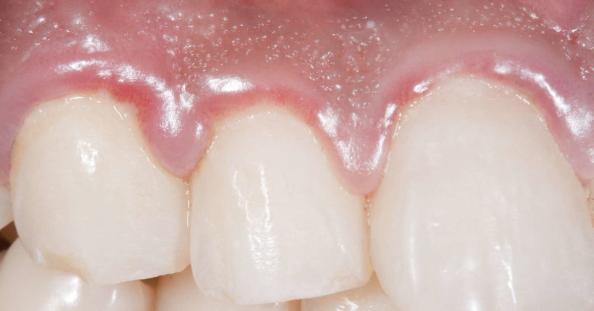 Pain in teeth and 2025 gums on one side