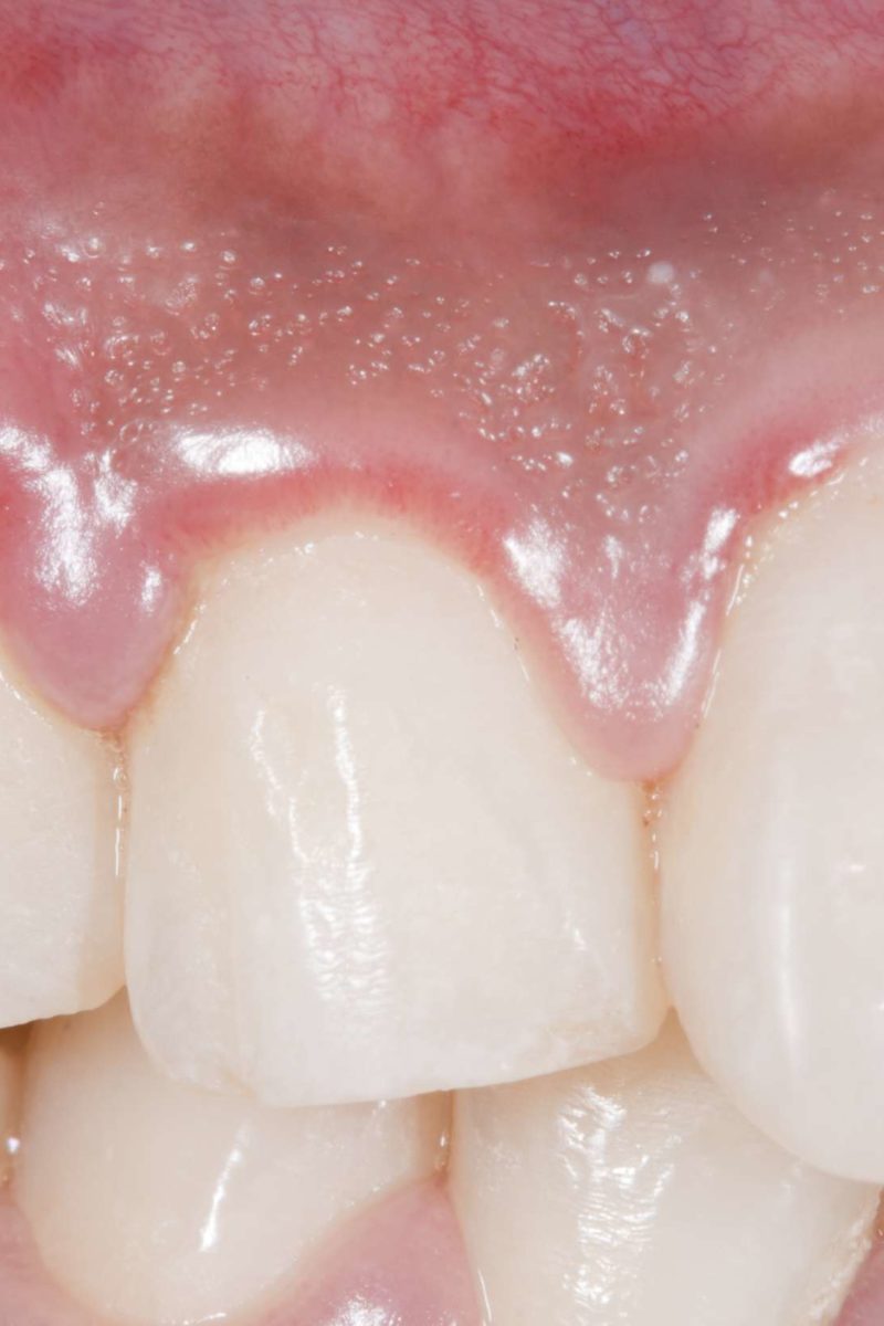 Treatment For Painful Swollen Gums