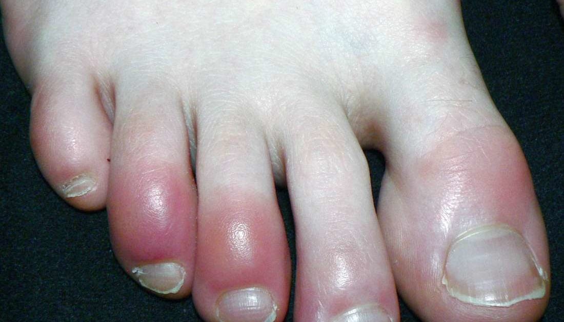 why-are-my-toes-red-causes-other-symptoms-and-treatments