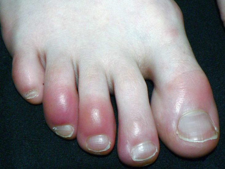 Broken Pinky Toe Symptoms Treatment And Other Conditions