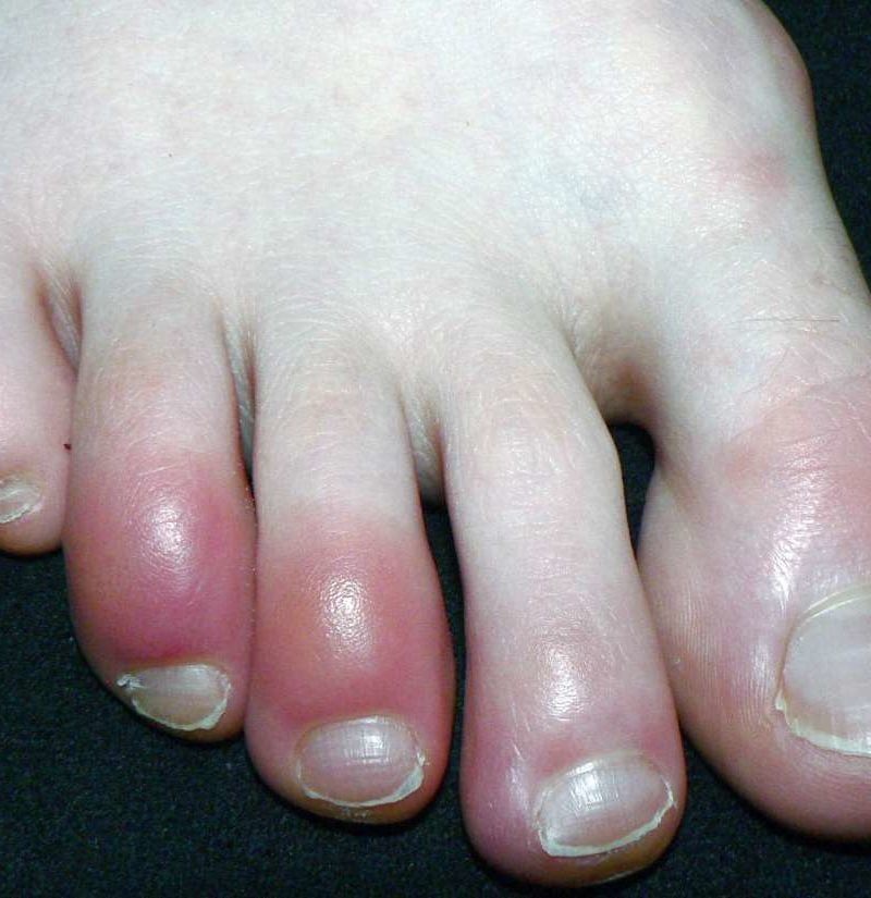 Light skin toes