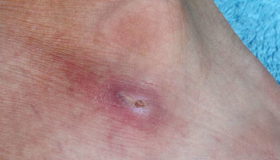 what-causes-red-spots-on-the-feet-other-symptoms-and-treatment