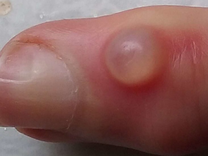 Hi, Does this look like nail fold changes linked to scleroderma to you? I  have positive antibodies and a ton of symptoms but been dismissed by  reumatologist. : r/scleroderma