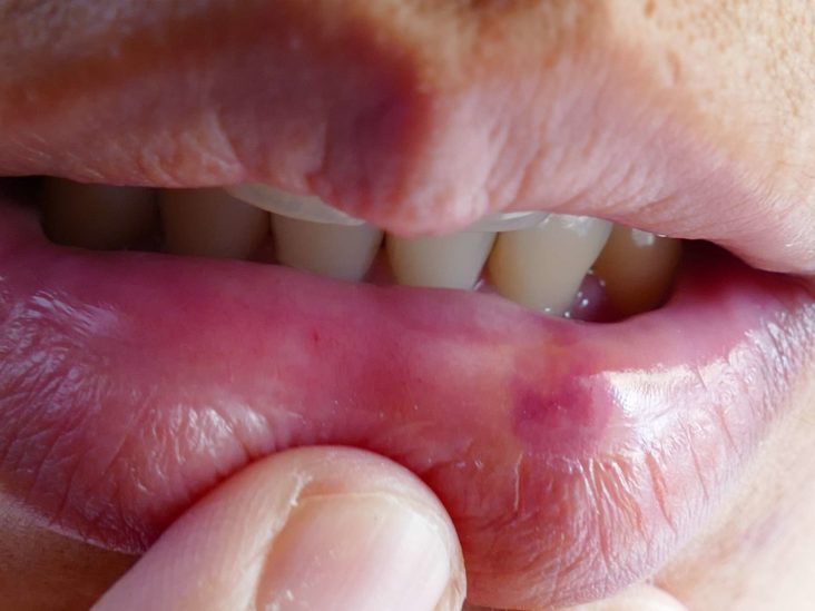 angular-cheilitis-pictures-treatment-symptoms-causes-lip-hot-sex-picture