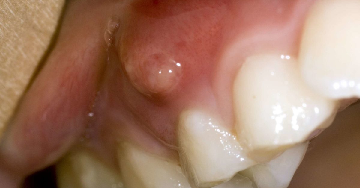 Gum Boil After Wisdom Teeth Removal