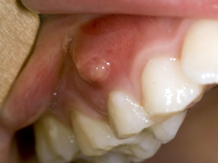 Gum poking through of tooth What a