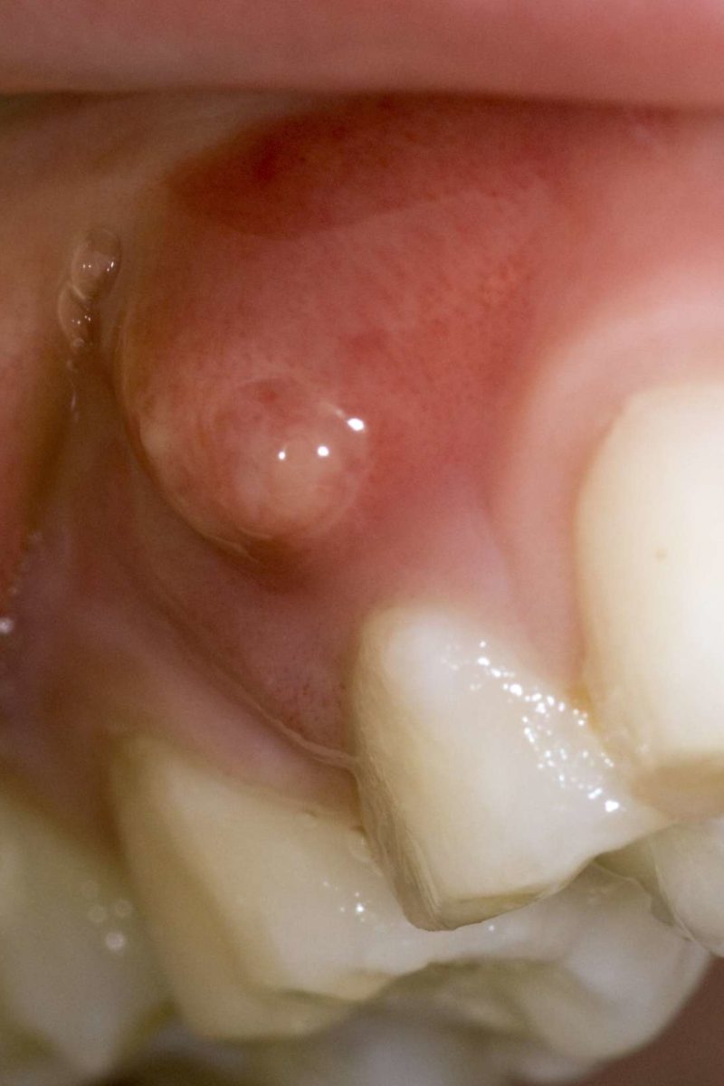 Gum boils: What they are and how to treat them