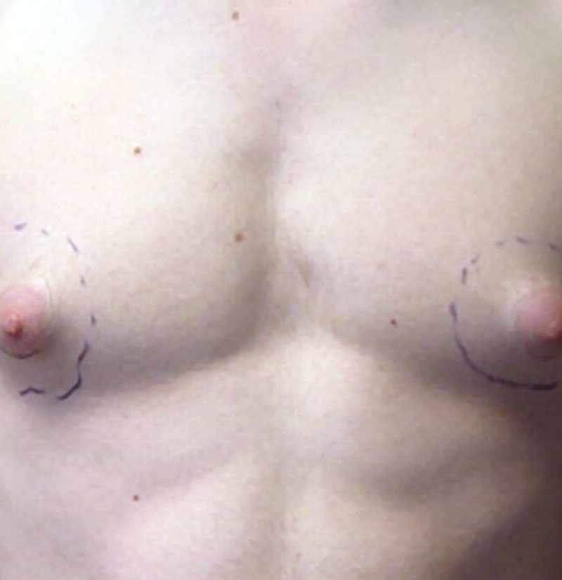 Puffy Nipple Breasts