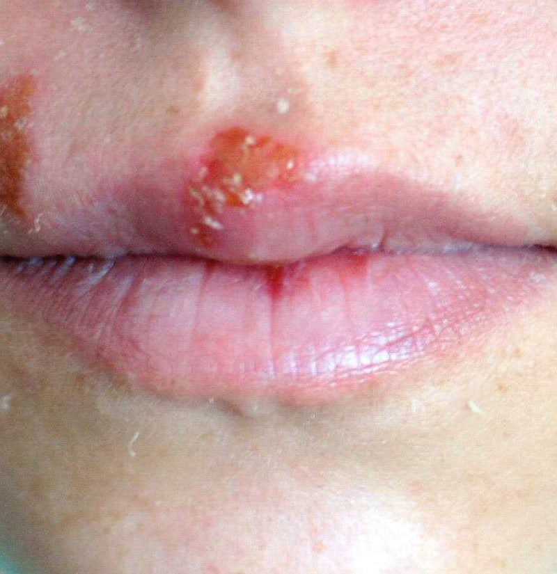 herpes on cheek of face