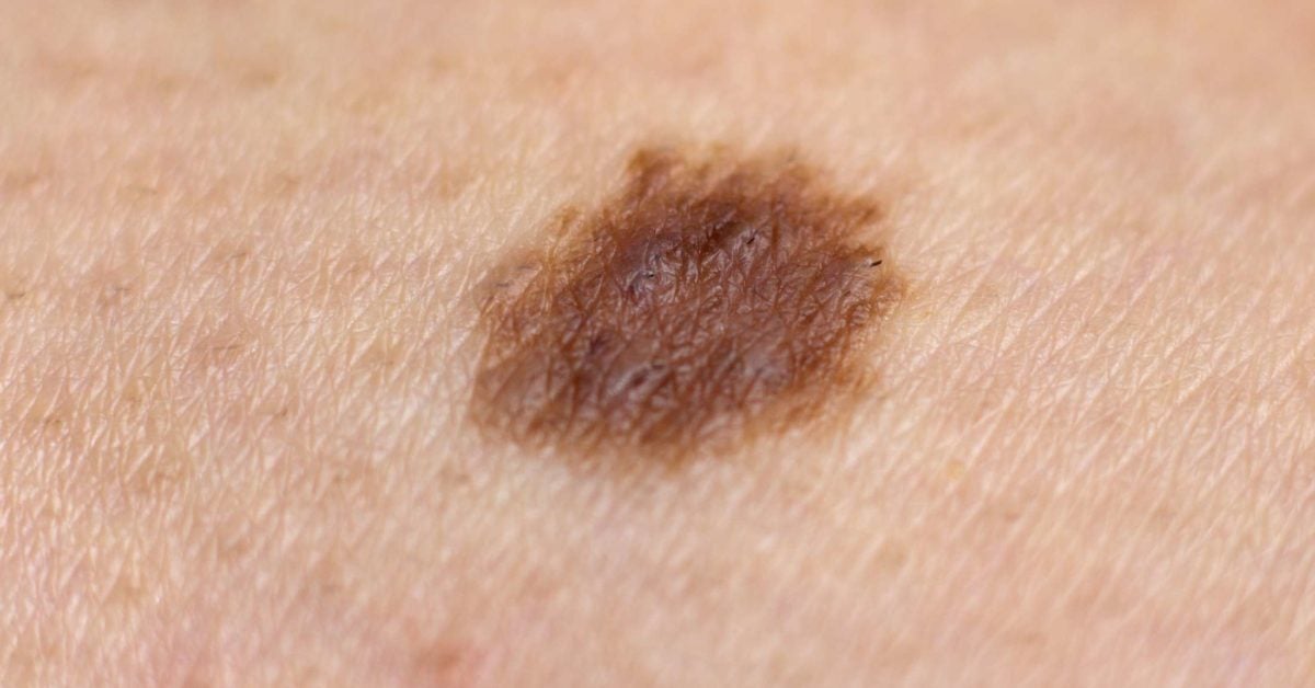 Mole on Scalp: Types of Moles, Risks, and Warning Signs of Melanoma