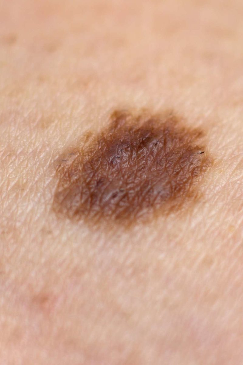 skin-cancer-moles-on-back-idaman