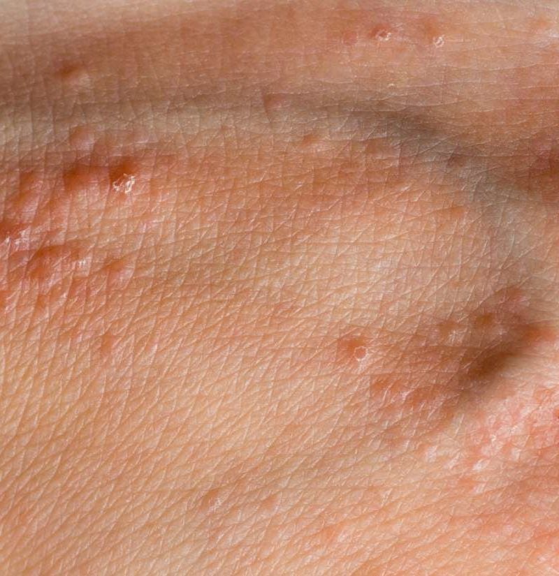 Itchy Bumps On Hands