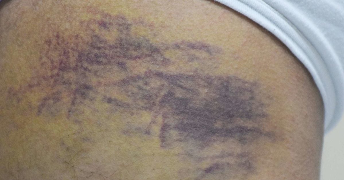 Bruises On Dark Skin Symptoms And Treatment